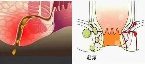 痔疮是什么原因引起的？别老想着自愈，这几个症状一定要注意！