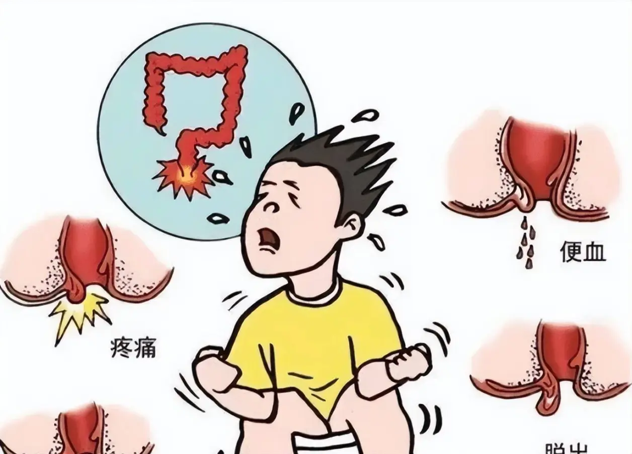 痔疮是怎么引起的？关于痔疮的治疗和预防