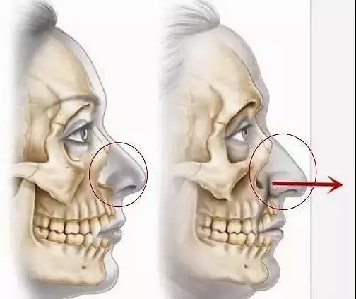 出现,一般有两种情况 01,鼻基底低造成的法令纹 属于骨骼问题