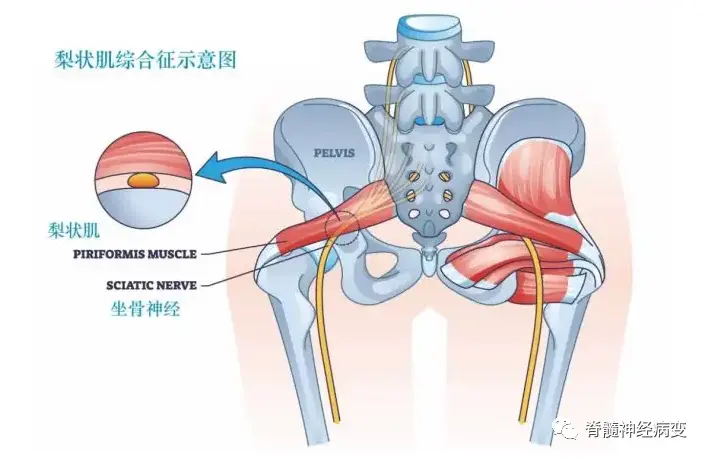 什么是梨状肌炎症？梨状肌综合症？