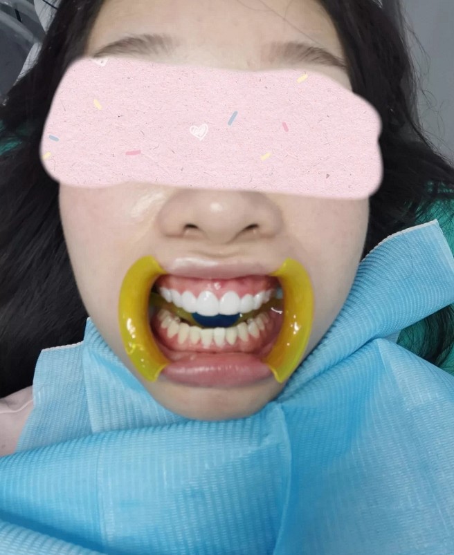 杭州探店——做牙齿贴面的真实感受