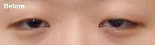 上睑提肌无力是什么导致的