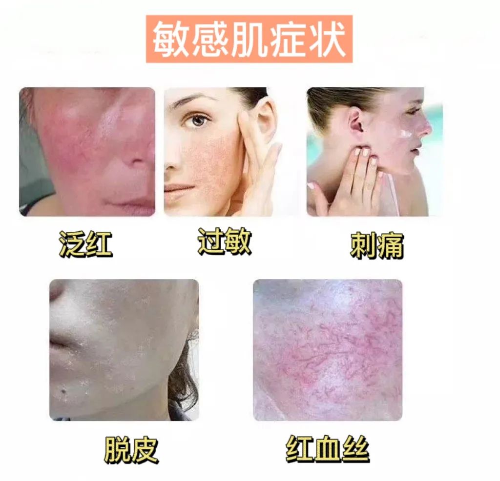 nymphara瑶纯|敏感肌的症状有哪些