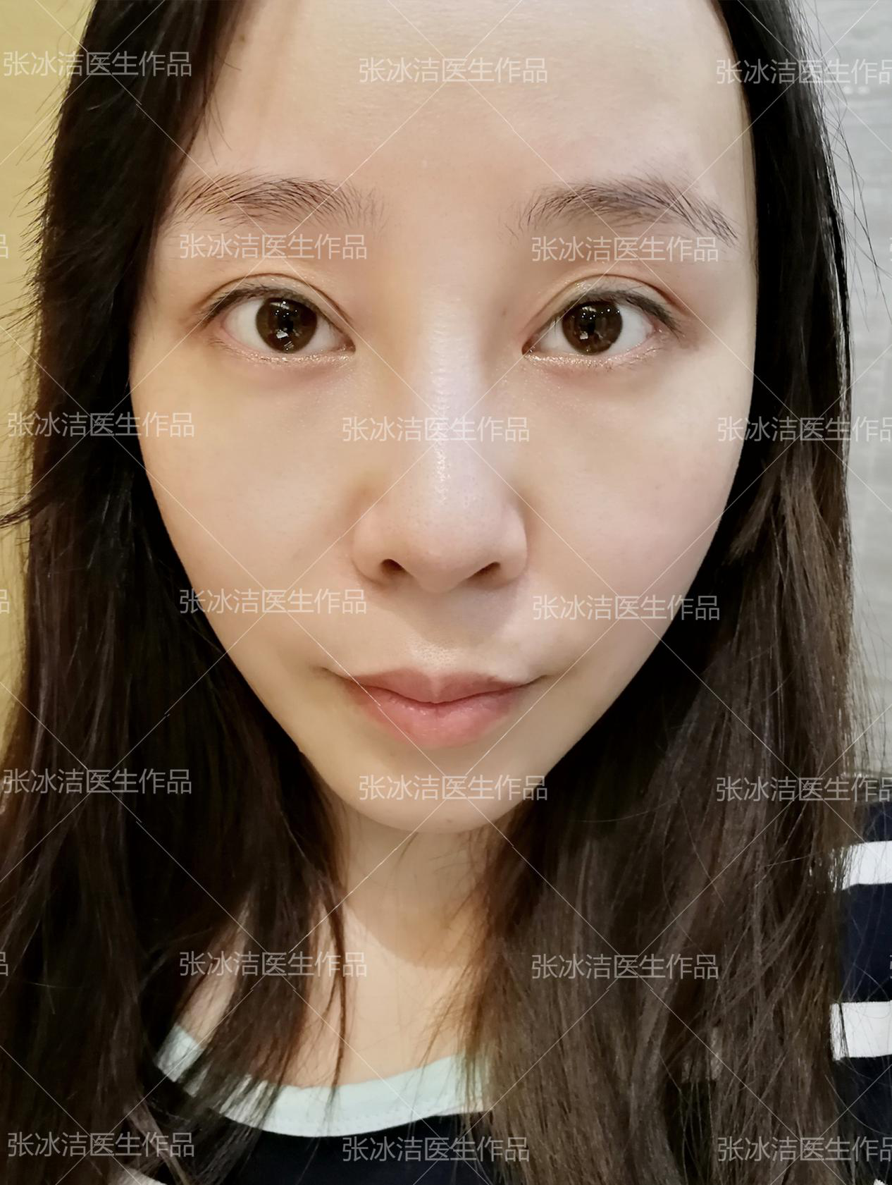 张冰洁双眼皮不对称修复案例丨双眼皮肉条修复 开扇改