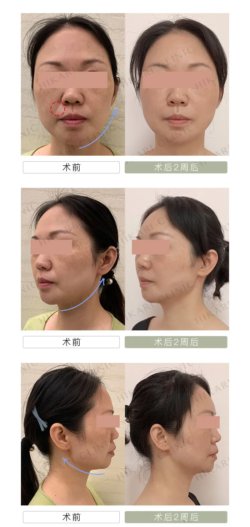 昨晚梦见脸上长了很多汗毛，究竟意味着什么？