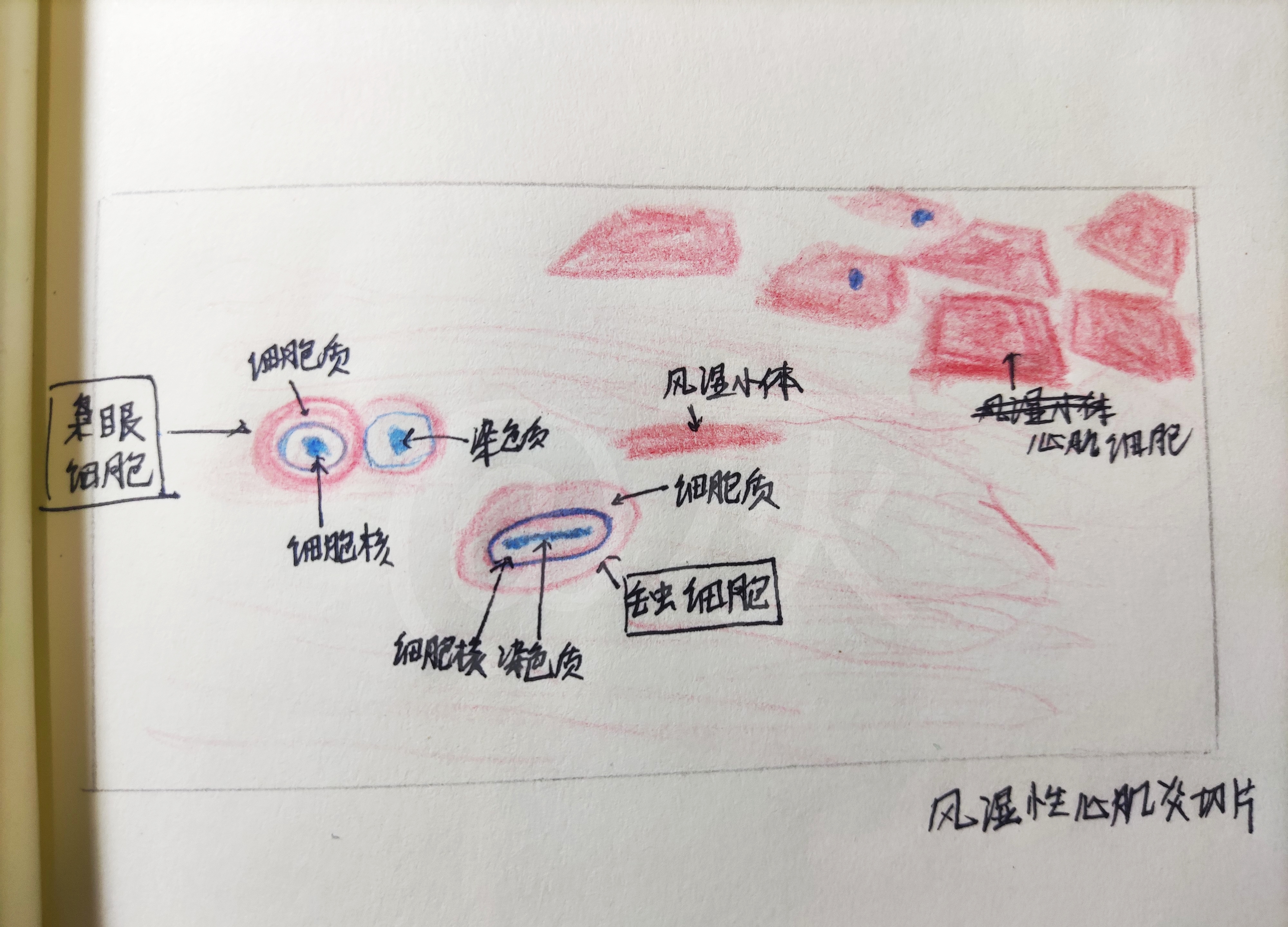 (手残实验画图)动脉粥样硬化,风湿性心肌炎