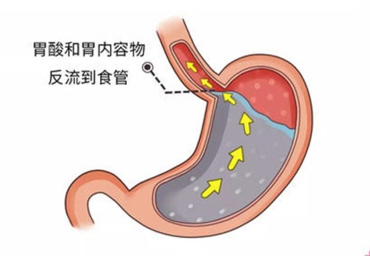 如何预防缓解胃食管反流?