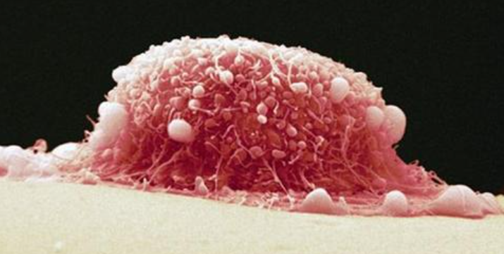 宫颈癌的病因明确,它与高危型人乳头瘤病毒(hpv)持续感居有关.