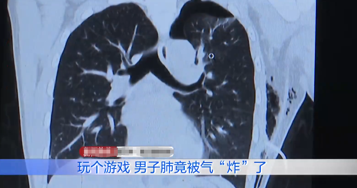 真肺都气炸了!因玩游戏时队友太坑,男子肺大泡炸裂!
