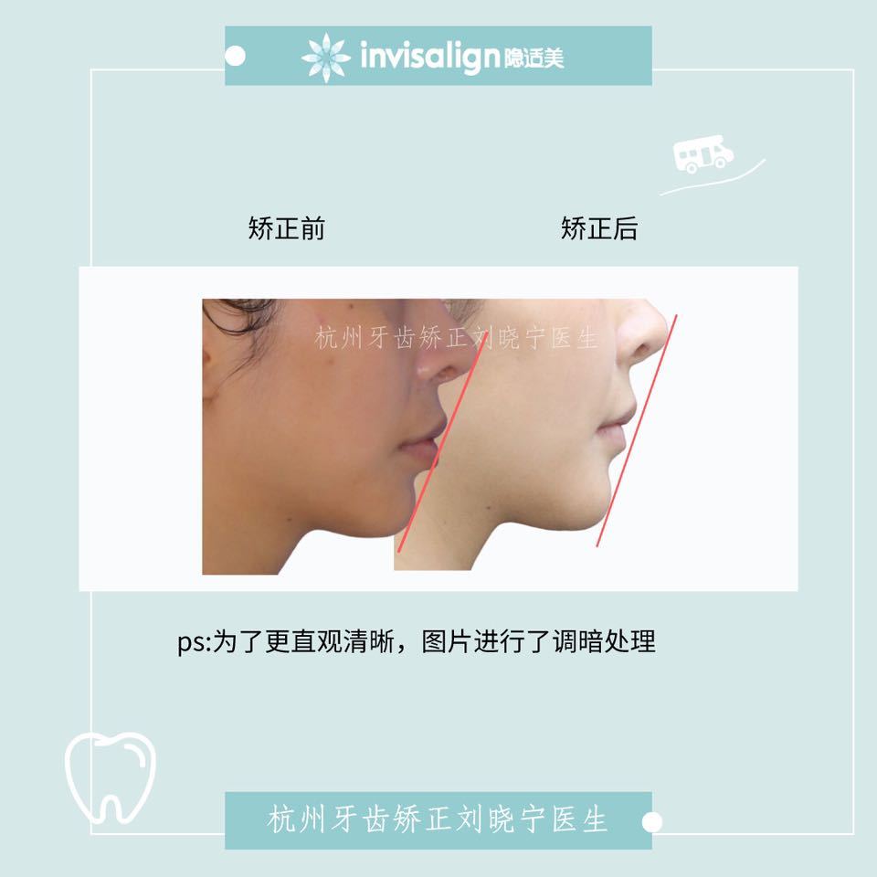 杭州牙齿矫正刘晓宁正畸案例:适度改善侧貌,达到对侧貌及美观的高标准