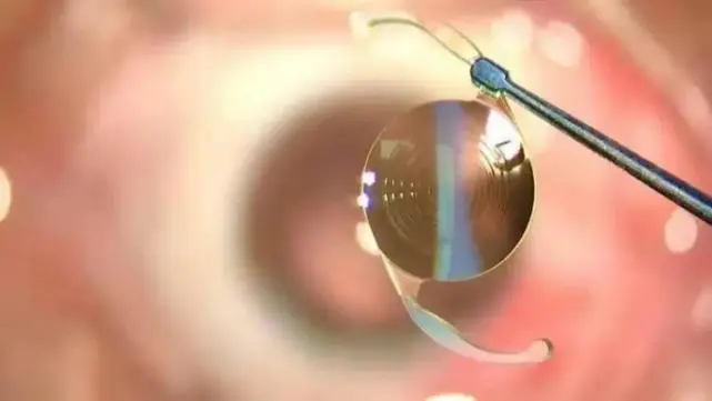 白内障患者自述：三焦点人工晶体眼部手术全纪录