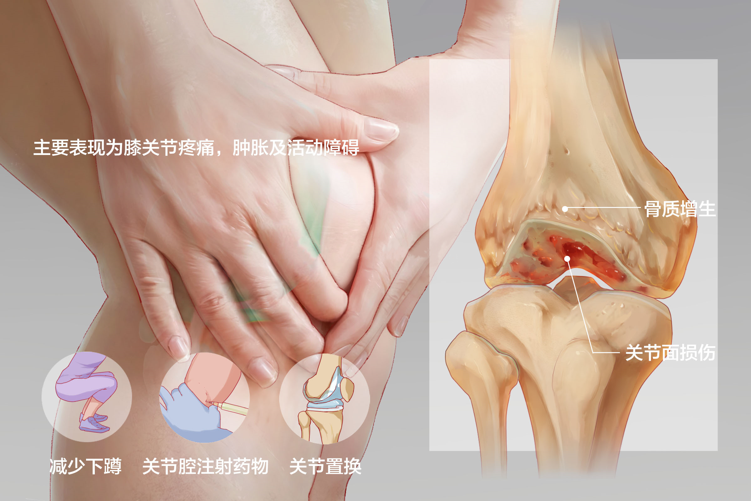 当膝关节出现这些症状就要注意了,可能是膝关节炎!