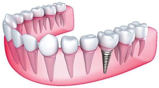 泉州种植牙的过程难受吗   由于求美者体质及手术过程不同,种植牙完成