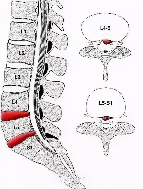 为什么腰4、腰5及腰5、骶1椎间盘突出症最为常见？