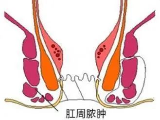 屁股上面长了一个奇怪东西怎么办