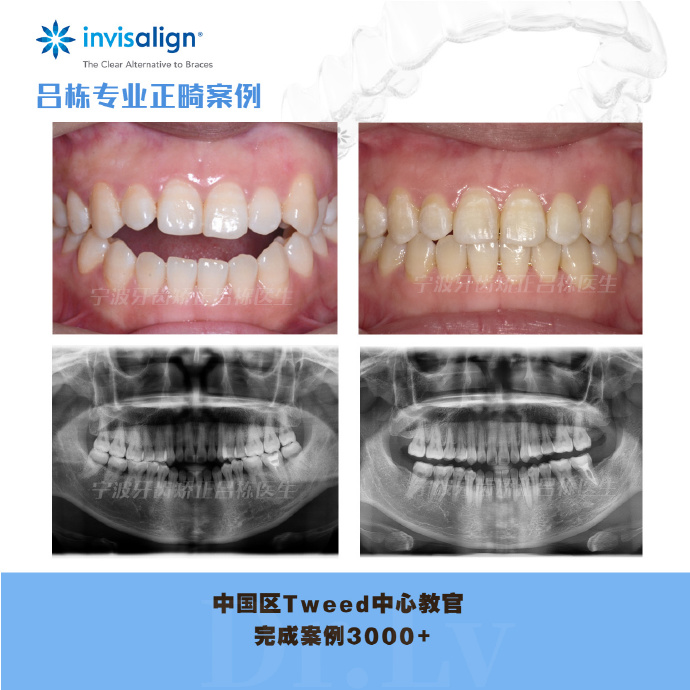 宁波牙齿矫正吕栋正畸案例:由于不良习惯吐舌引起的开颌|矫正改善开颌