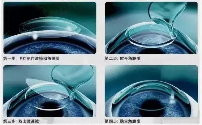 度数高怎么选择隐形眼镜,度数高怎么选择隐形眼镜镜片