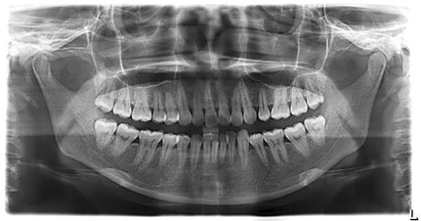 口腔全景片(曲面断层片)