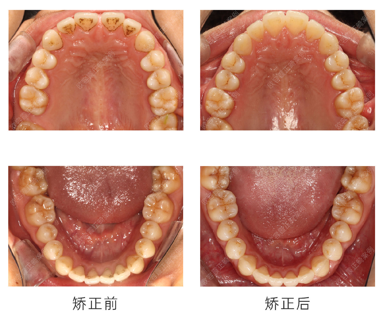 口内检查: 1,17缺失,18近中倾斜,上前牙区多个散在间隙总约3mm,下前