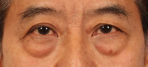 厦门去眼袋哪家好去眼袋的方法有哪些