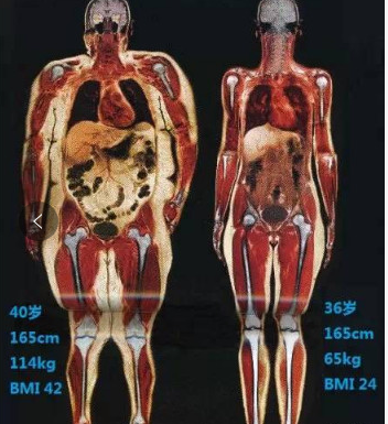 "胖子"的内脏脂肪含量也明显高于"瘦子"