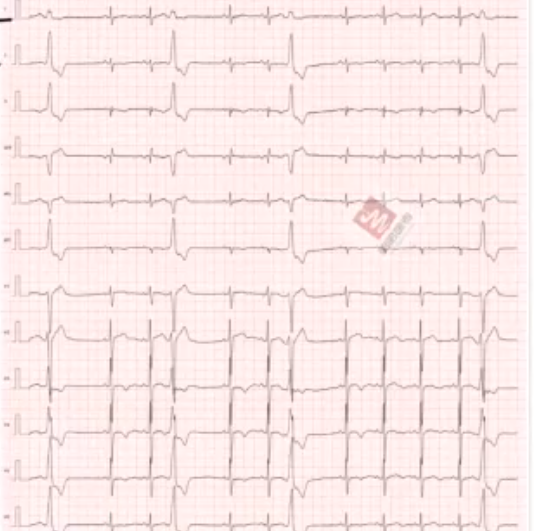 房颤p啵月亮弯,二度阻滞不难看 m型{p啵:二尖瓣   /  qrs:束支传导