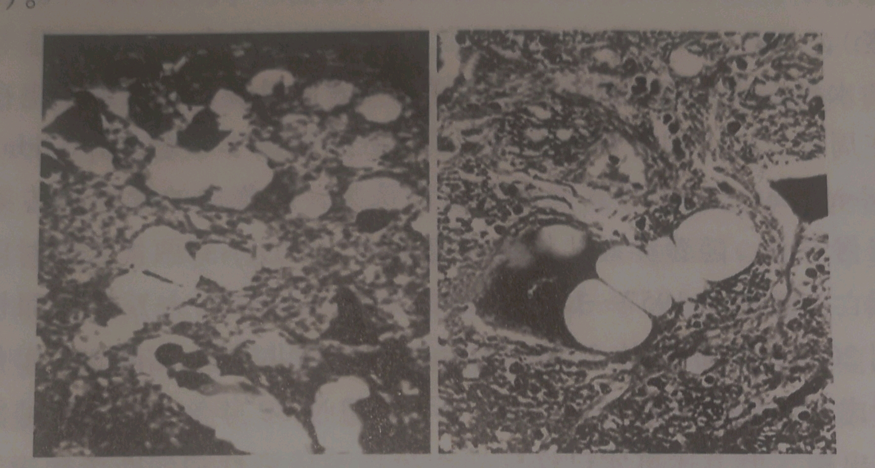 库鲁病(左)和羊瘙痒症(右)的病变脑组织病理切片.
