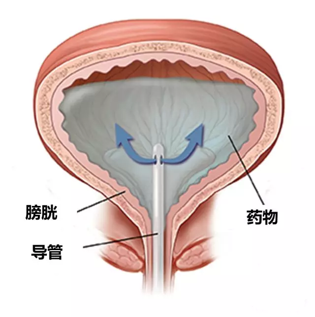 患者自述:我做膀胱灌注的"十二时辰"