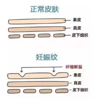 加之腹部膨隆使皮肤的弹力纤维与胶原纤维损伤或断裂,腹部皮肤变薄变