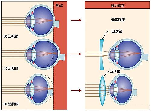 晶状体过凸,光线成像在视网膜前方,使人看不清远方物体,可以用凹透镜