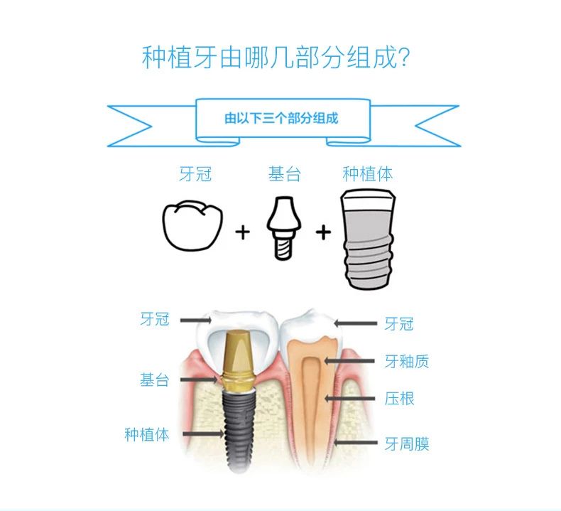 口腔健康专栏—种植牙