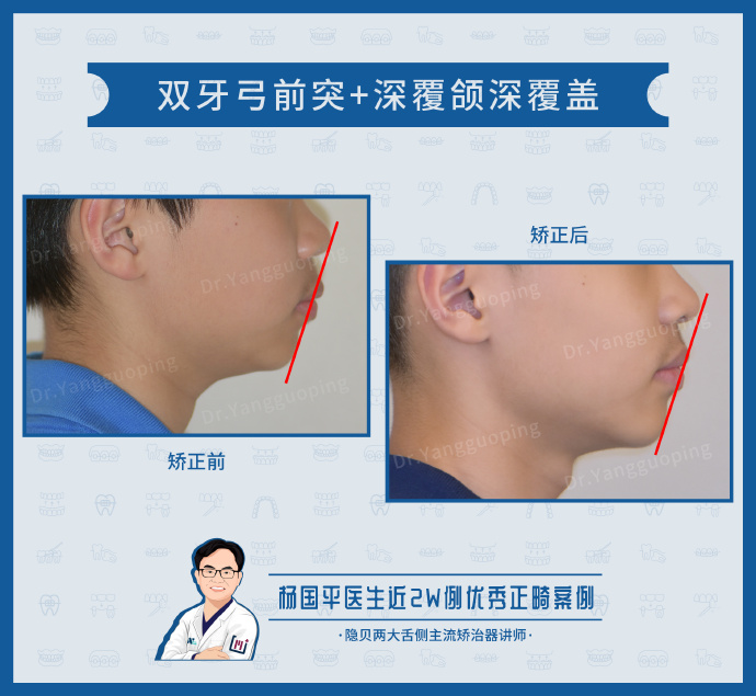 上海舌侧牙齿矫正杨国平正畸案例:治疗关闭牙列间隙,改善前突建立正常