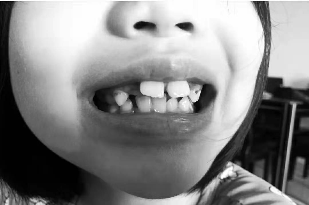 儿童专业牙膏护牙剂:谨慎影响宝宝颜值的牙齿小问题!