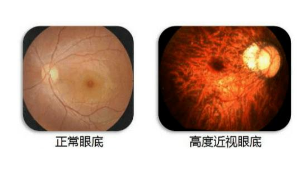 怎么看眼镜度数太高,怎么看眼镜度数