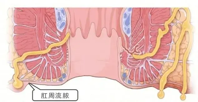 肛瘘是怎么形成的?那个仁同肛肠医院看的仔细专业吗？