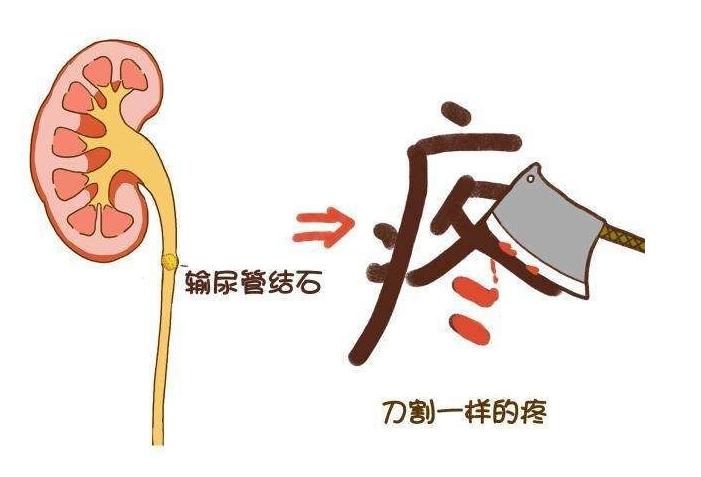 导致结石硌着输尿管,导致输尿管痉挛疼痛,而输尿管一