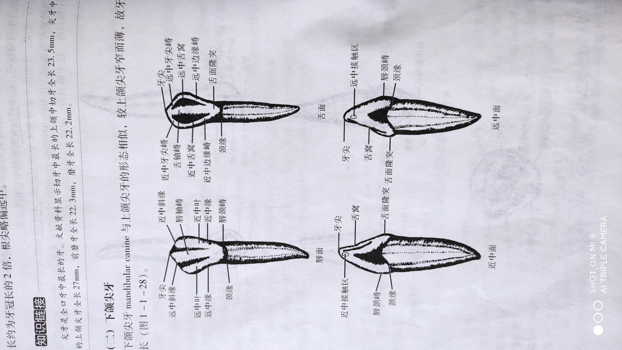 右侧下颌尖牙