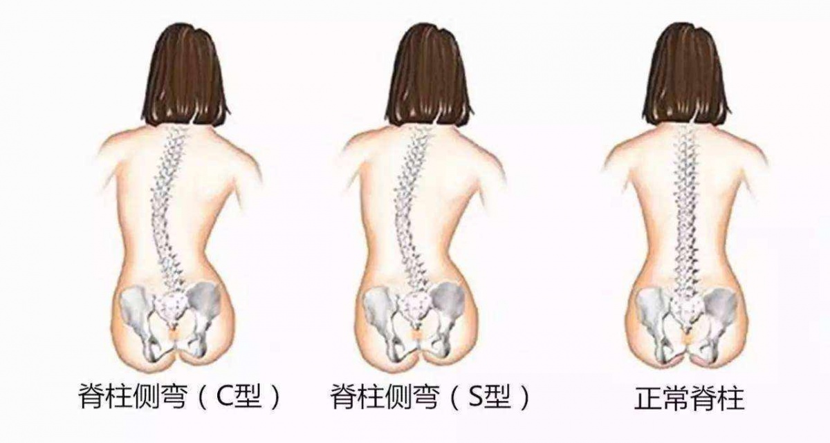 不要让孩子输在饮食上,强身壮骨,让孩子远离驼背