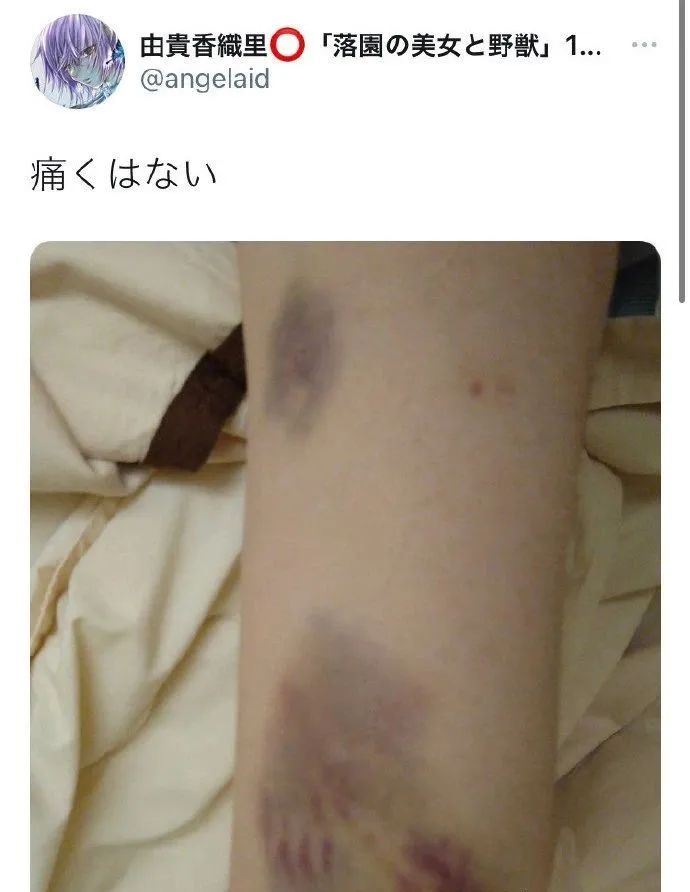 接受注射到淤青的手臂