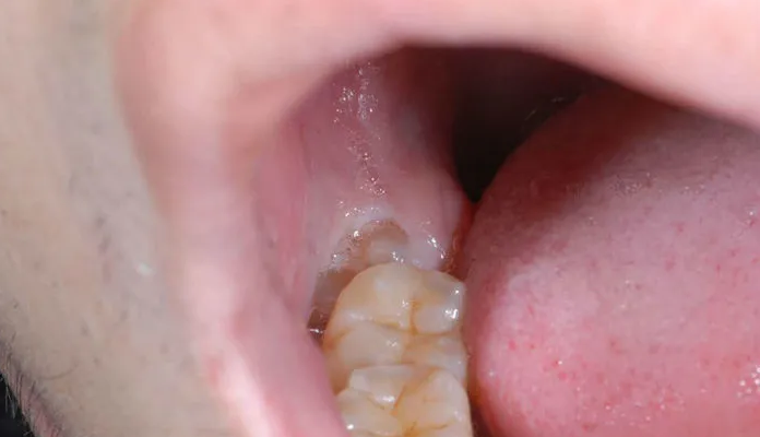 智齿在发育过程当中,也许会不痛不痒,但它却可能送你一个 颌骨囊肿