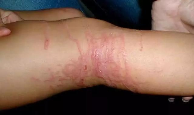 科技 自然 伊鲁康吉的诅咒 被水母蛰伤后 既然是水母蛰伤,那么就要