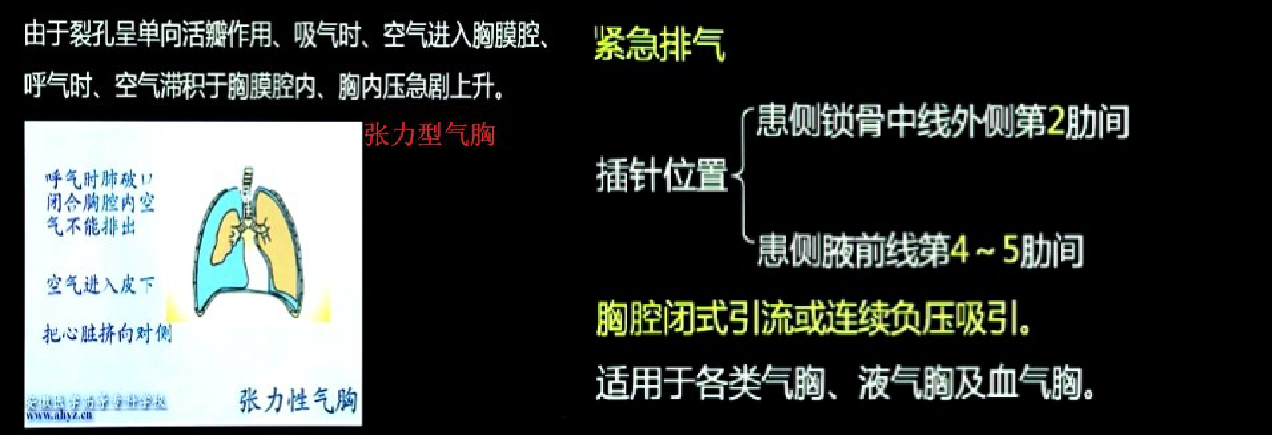 张力型气胸的(3)发病机制与(4)治疗.看!锁骨中线外侧第二肋!
