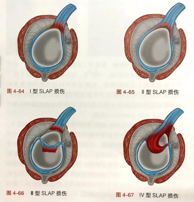 肩关节常响担心患病了医生这4种原因损伤最常见