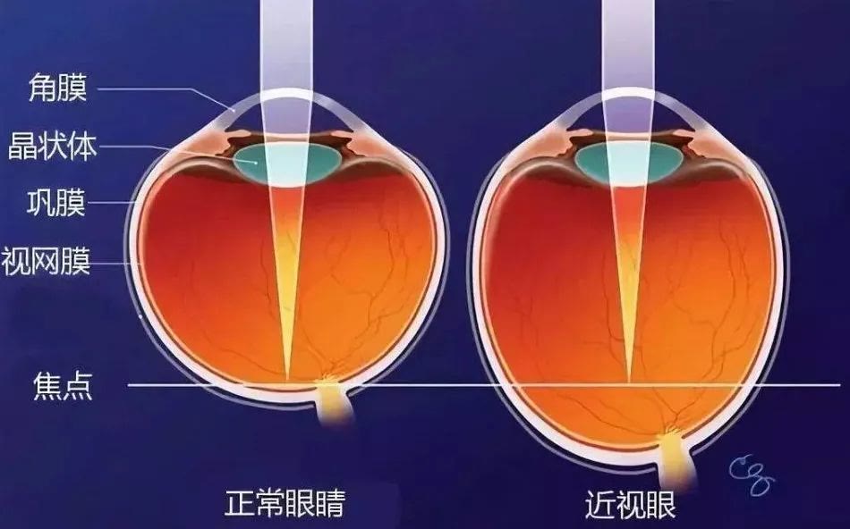 多近视眼呢？想要知道近视产生的原因，我们首先要了解眼睛的工作原理。