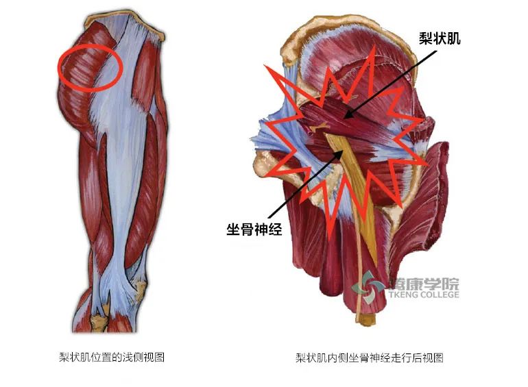 梨状肌综合征分析与检查