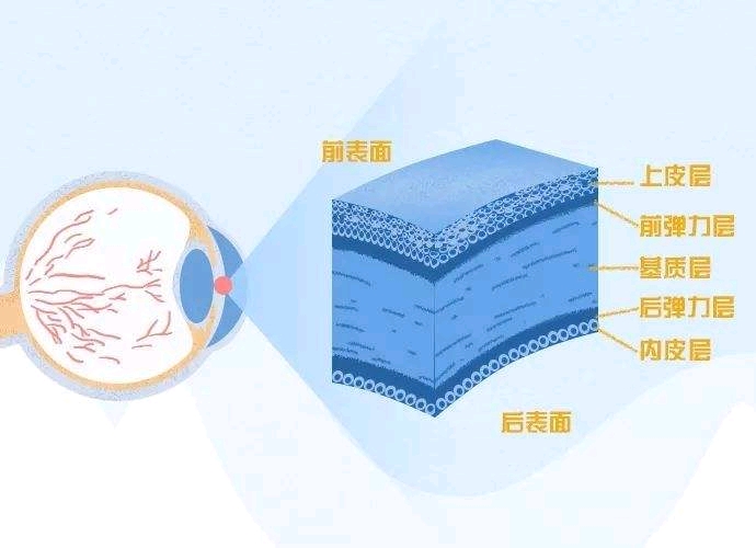 角膜分层示意图