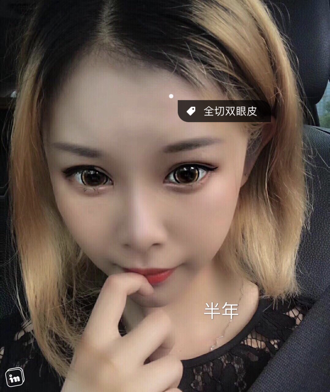 全切双眼皮
