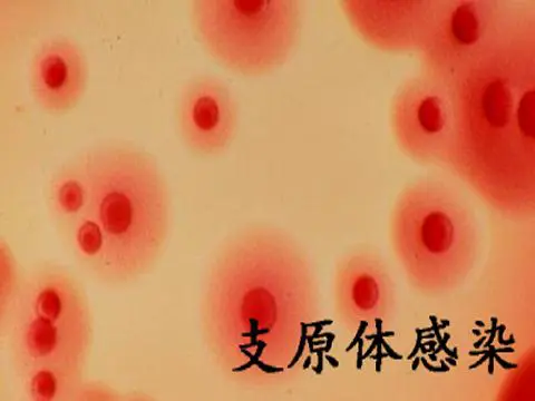 支原体感染引起不孕怎么治疗