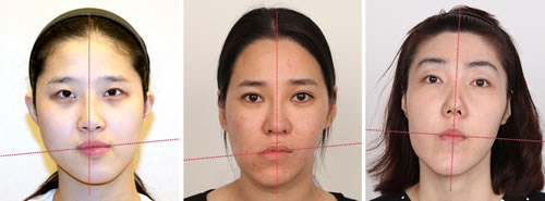 矫正牙齿对脸型的影响大吗什么样的情况下脸型改变会更明显