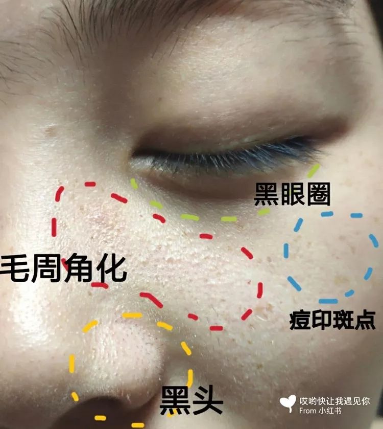 毛孔泛红,肩胛,前臂,小腿以及许多人胳膊鸡皮泛红都是属于毛周角化的